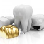 歯のかぶせもの