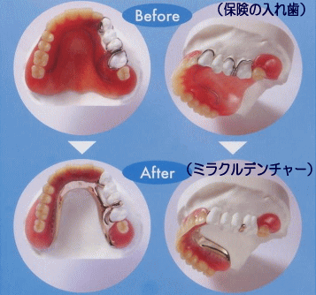 ミラクルはミラクルタッチ（維持装置）を使った部分入れ歯です。